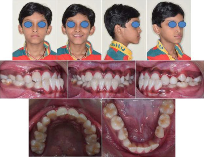 Handsome From Certain Angles: My Class III Malocclusion Story