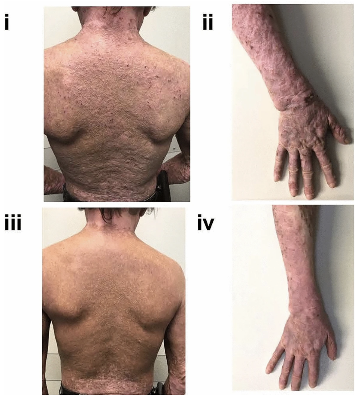 Sever atopic dermatitis before and after dupilumab