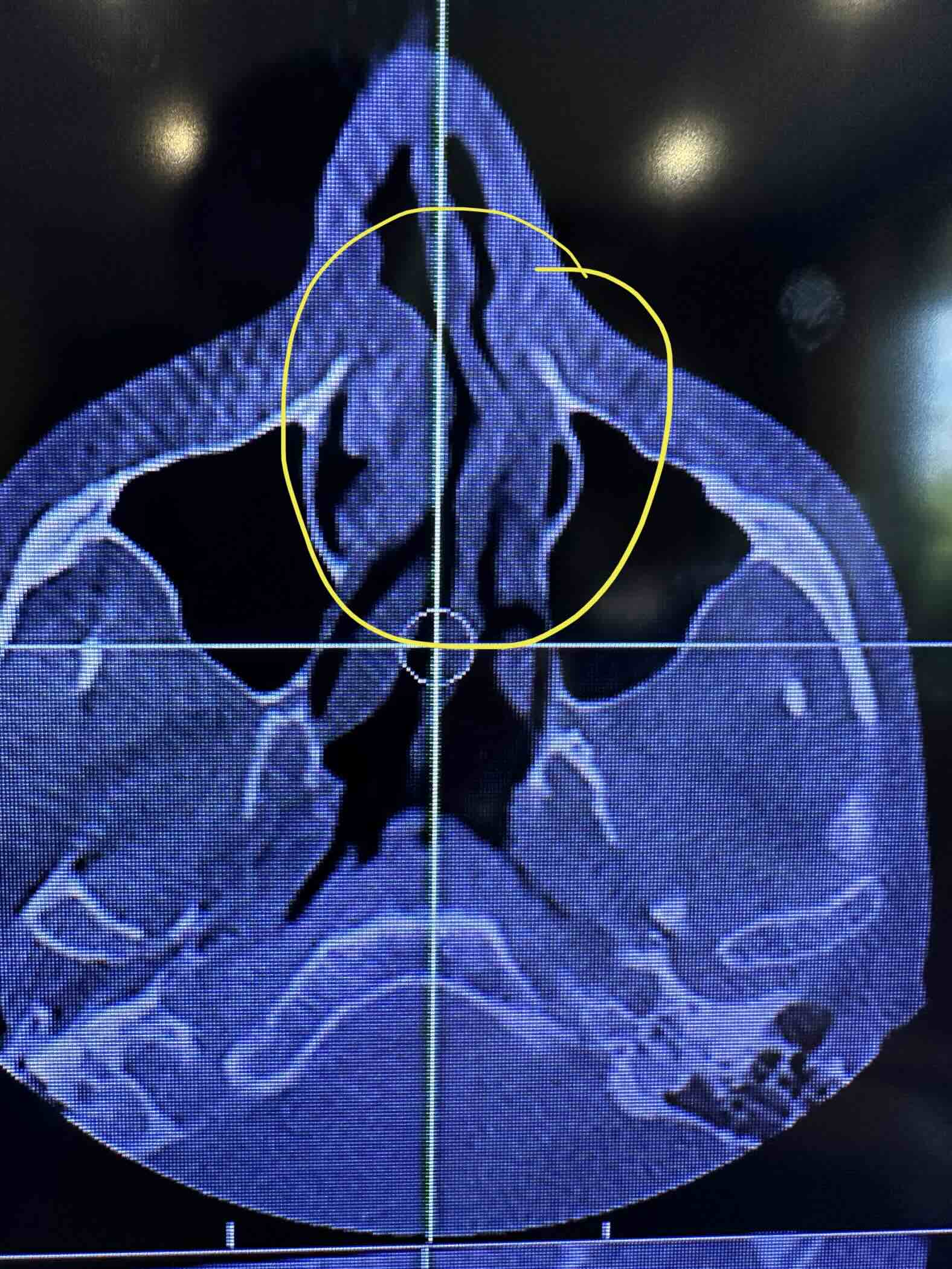 Deviated Septum